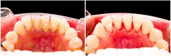 How to Remove Tartar From Teeth Without Dentist